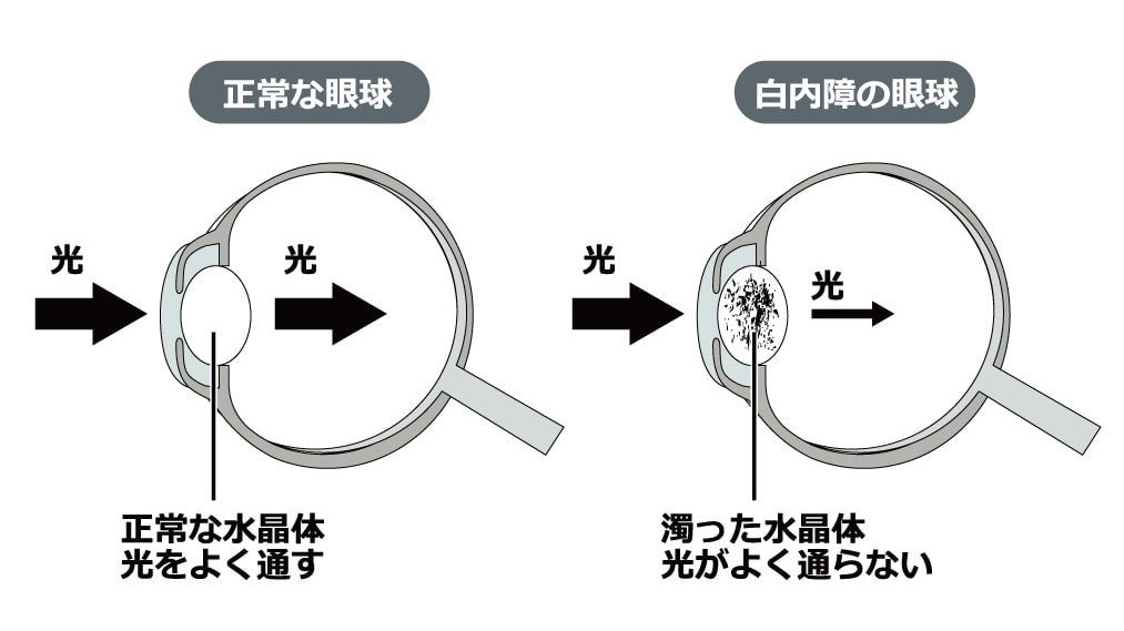 白内障の症状